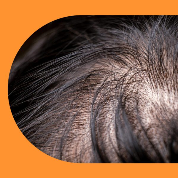 Hair loss and thin hairs