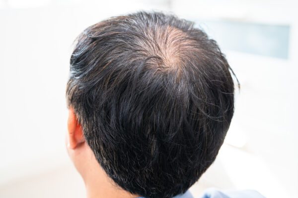 hair loss treatment